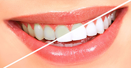 diş beyazlatma tedavisi incirli, diş beyazlatma bahçelievler, bahçelievler diş beyazlatma tedavisi