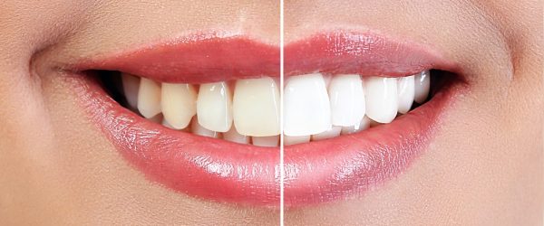 diş beyazlatma tedavisi bahçelievler, bahçelievler diş beyazlatma tedavisi