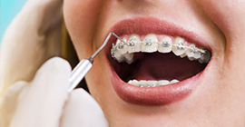 incirli ortodonti tedavisi, ortodonti tedavisi bahçelievler, bahçelievler ortodonti tedavisi, şeffaf plak ve diş teli tedavisi bahçelievler
